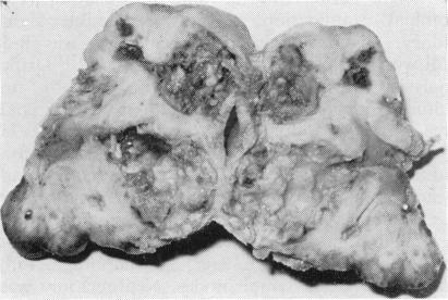 https://cdn.ncbi.nlm.nih.gov/pmc/blobs/1d14/1627722/702c07f2cac9/archdisch00755-0076-a.jpg