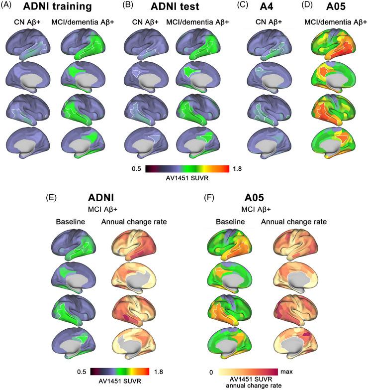 https://cdn.ncbi.nlm.nih.gov/pmc/blobs/1d41/12060132/c11cf1d992a9/ALZ-21-e70170-g004.jpg
