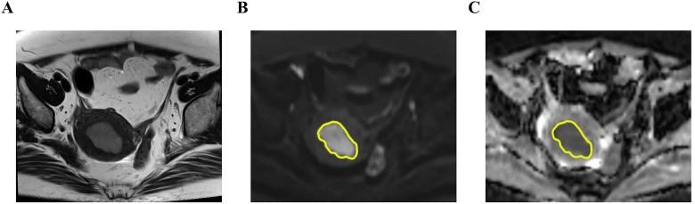 https://cdn.ncbi.nlm.nih.gov/pmc/blobs/1d49/12039310/3bf5d4647de6/fonc-15-1565152-g002.jpg