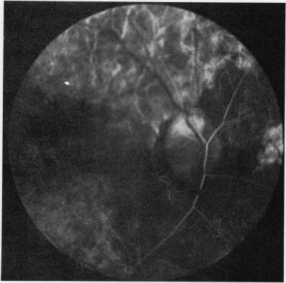 https://cdn.ncbi.nlm.nih.gov/pmc/blobs/1db4/1215075/03131286df41/brjopthal00276-0024-a.jpg