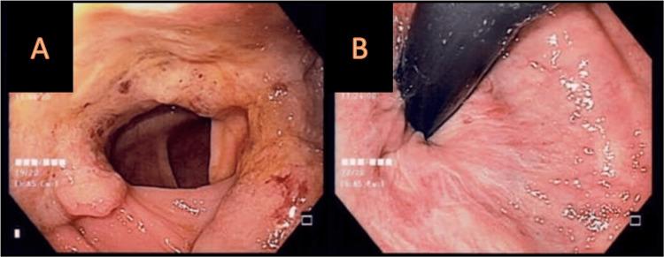 https://cdn.ncbi.nlm.nih.gov/pmc/blobs/1de4/10702251/1bf5025892d7/cureus-0015-00000048437-i02.jpg