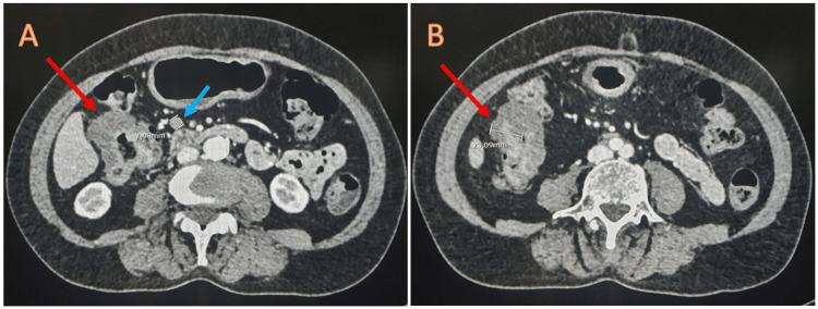 https://cdn.ncbi.nlm.nih.gov/pmc/blobs/1de4/10702251/23b9c1e7717b/cureus-0015-00000048437-i03.jpg