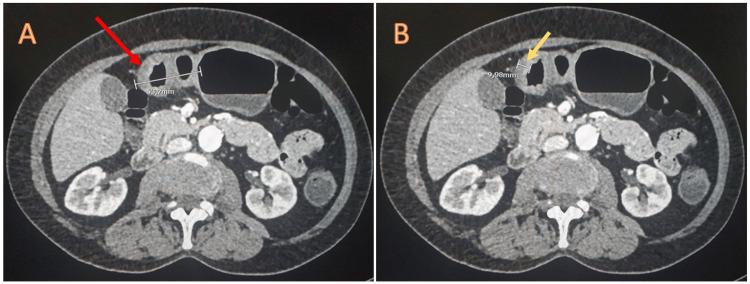 https://cdn.ncbi.nlm.nih.gov/pmc/blobs/1de4/10702251/b1ebaeecbca8/cureus-0015-00000048437-i04.jpg