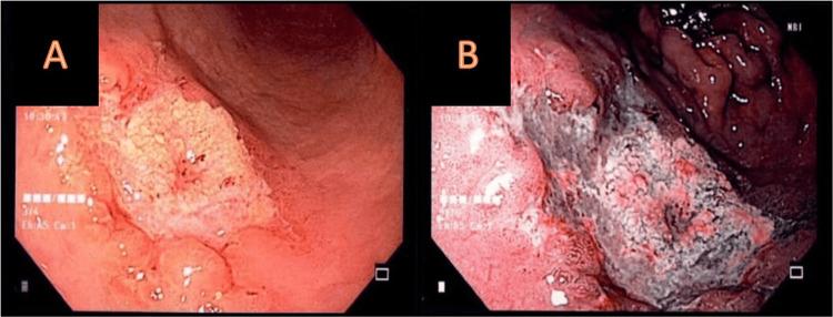 https://cdn.ncbi.nlm.nih.gov/pmc/blobs/1de4/10702251/eb65e17d1fe9/cureus-0015-00000048437-i01.jpg