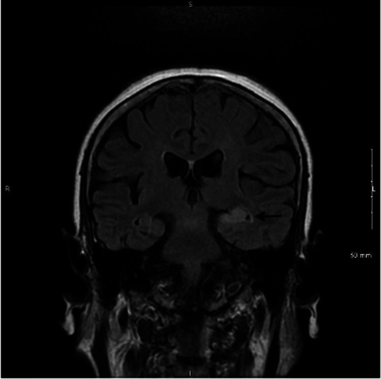 https://cdn.ncbi.nlm.nih.gov/pmc/blobs/1e4b/11097232/8f2801b6696b/cureus-0016-00000058406-i01.jpg