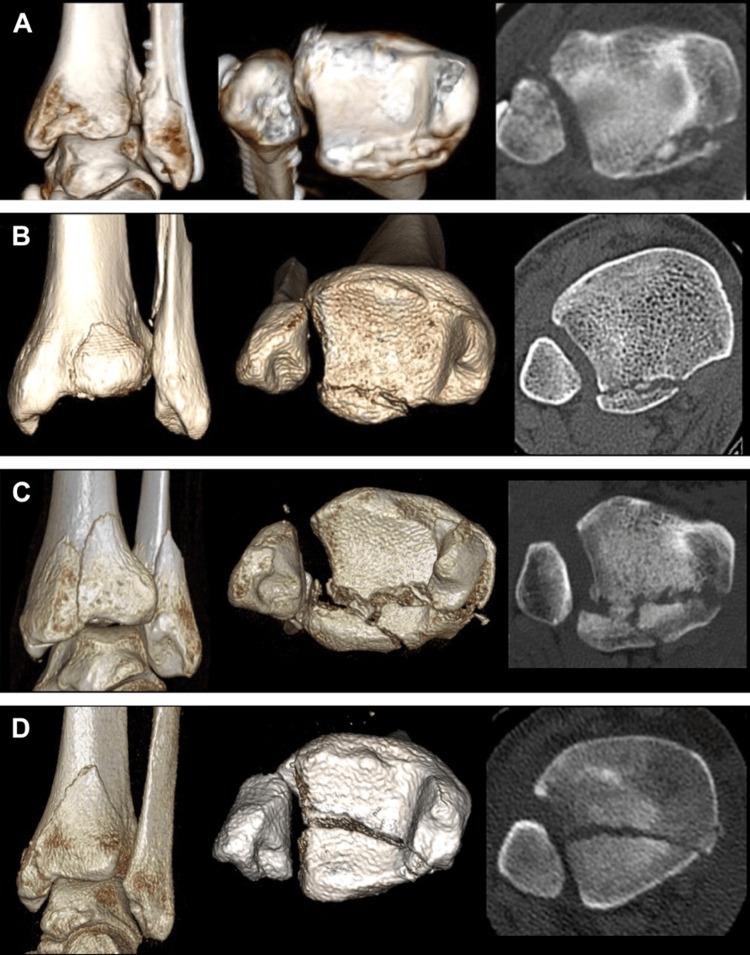 https://cdn.ncbi.nlm.nih.gov/pmc/blobs/1e5e/11580813/4453e34bc3d3/cureus-0016-00000072081-i02.jpg