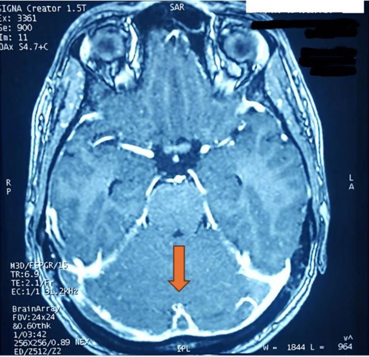 https://cdn.ncbi.nlm.nih.gov/pmc/blobs/1e63/12246765/93f6fa9a1ec7/cureus-0017-00000085742-i01.jpg