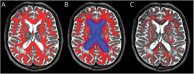 https://cdn.ncbi.nlm.nih.gov/pmc/blobs/1f06/11540458/e20bffa392ab/WNL-2024-102774f1.jpg