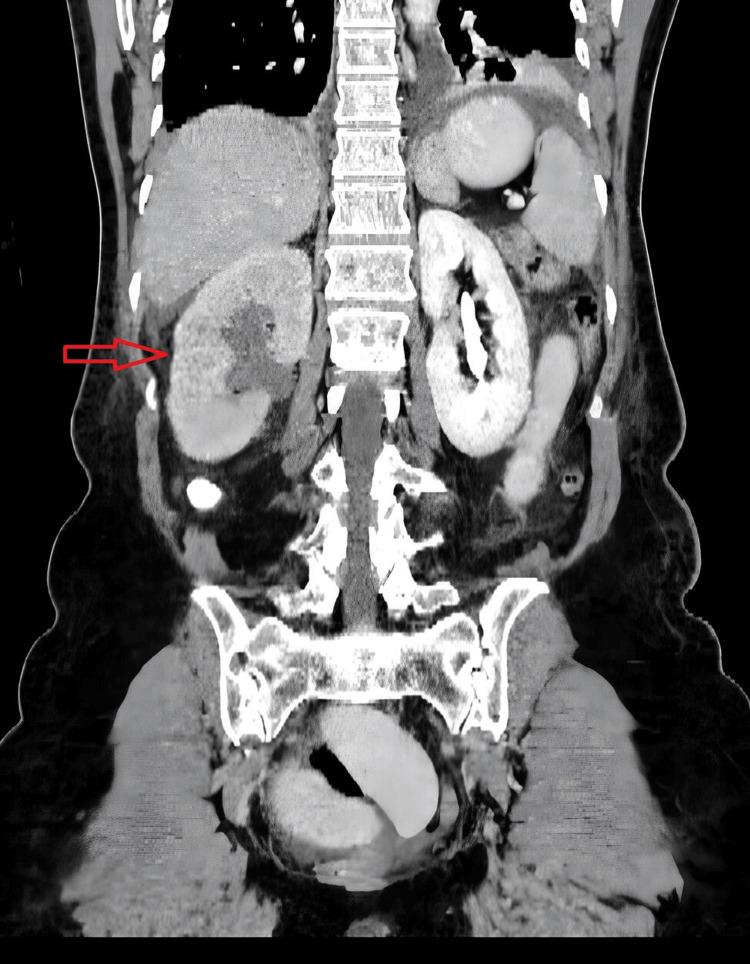 https://cdn.ncbi.nlm.nih.gov/pmc/blobs/1f26/11346821/d7295766e2f3/cureus-0016-00000065483-i01.jpg