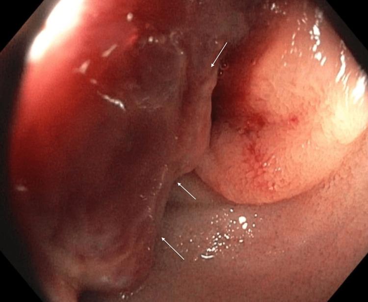 https://cdn.ncbi.nlm.nih.gov/pmc/blobs/1f2a/9840379/1ccc61646a26/cureus-0014-00000032554-i02.jpg