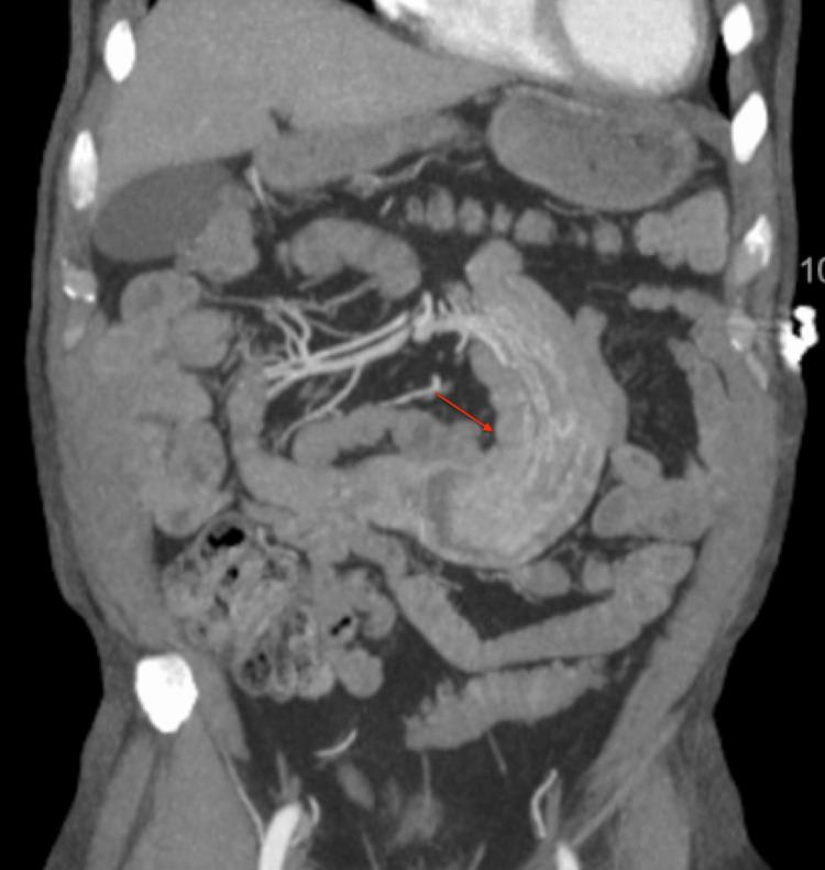 https://cdn.ncbi.nlm.nih.gov/pmc/blobs/1f2a/9840379/bcb34418f744/cureus-0014-00000032554-i05.jpg