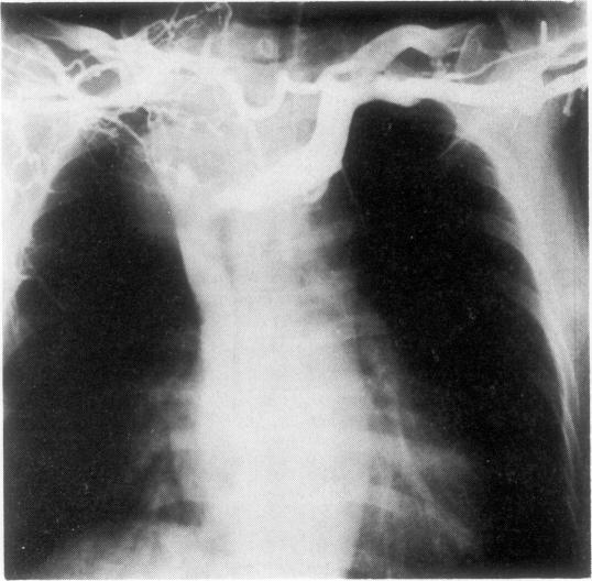 https://cdn.ncbi.nlm.nih.gov/pmc/blobs/1f95/470900/c7395ebe4773/thorax00159-0110-a.jpg