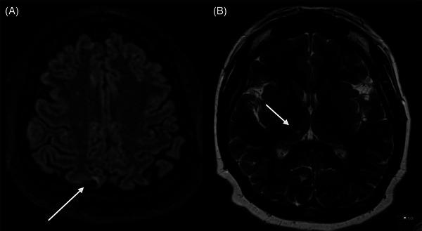 https://cdn.ncbi.nlm.nih.gov/pmc/blobs/1f98/11800375/57471c0ee6b5/JHA2-6-e1065-g002.jpg