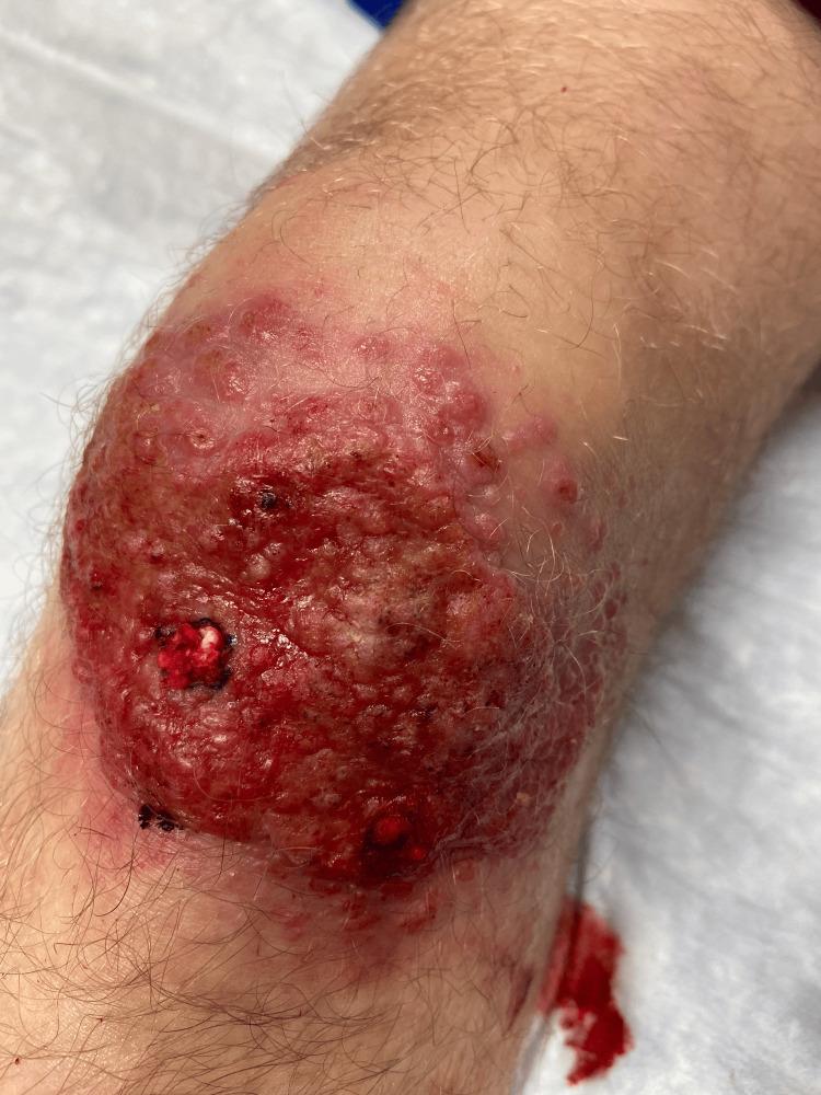 https://cdn.ncbi.nlm.nih.gov/pmc/blobs/2011/11463825/9ccd70636ec9/cureus-0016-00000069012-i01.jpg