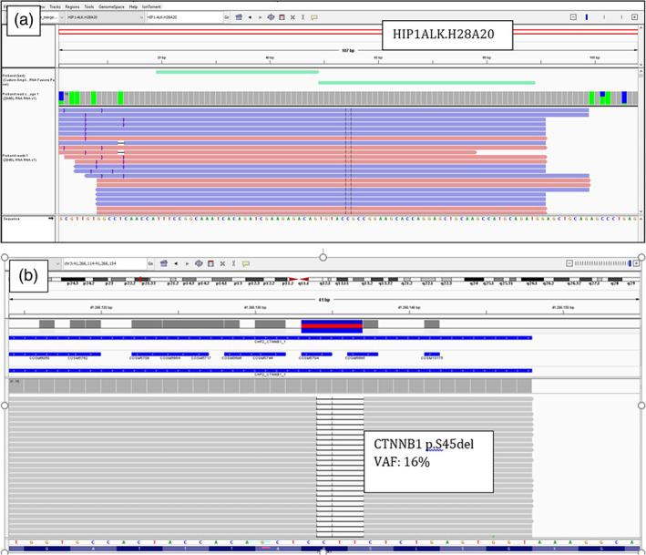 https://cdn.ncbi.nlm.nih.gov/pmc/blobs/2017/11543270/b9345ac6667b/TCA-15-2283-g002.jpg