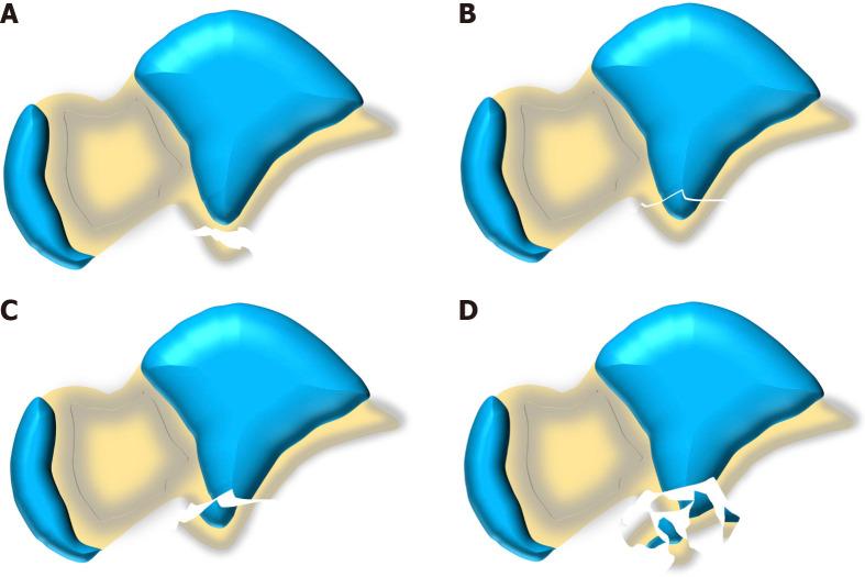 https://cdn.ncbi.nlm.nih.gov/pmc/blobs/202b/11135440/6275453a8235/WJCC-12-2487-g003.jpg