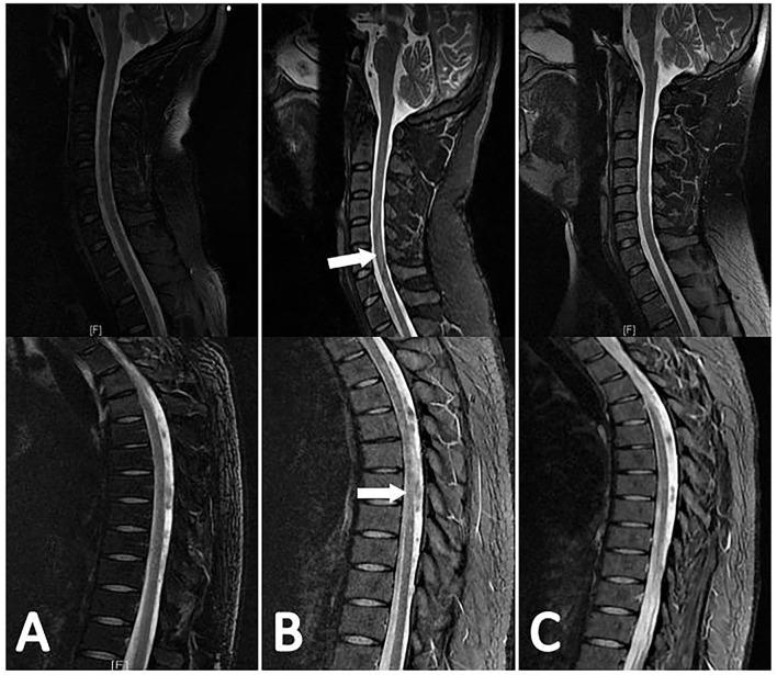 https://cdn.ncbi.nlm.nih.gov/pmc/blobs/2038/8965833/bb7d13f3e5e0/fneur-13-830029-g0004.jpg