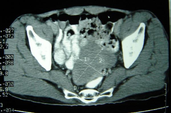 https://cdn.ncbi.nlm.nih.gov/pmc/blobs/2091/1876459/c274f2d4aca6/1477-7819-5-50-1.jpg
