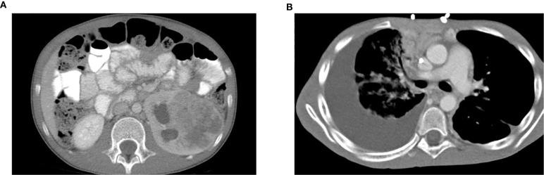 https://cdn.ncbi.nlm.nih.gov/pmc/blobs/2099/8032976/f4d5cb99f0cd/fonc-11-648097-g001.jpg