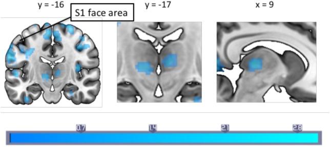 https://cdn.ncbi.nlm.nih.gov/pmc/blobs/209f/5816750/4a928242047d/fneur-09-00061-g002.jpg