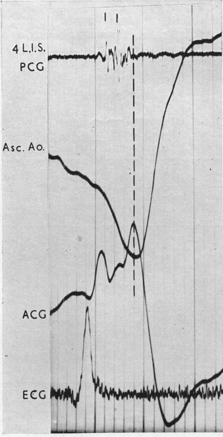 https://cdn.ncbi.nlm.nih.gov/pmc/blobs/20ae/503957/b9105720f215/brheartj00382-0033-b.jpg