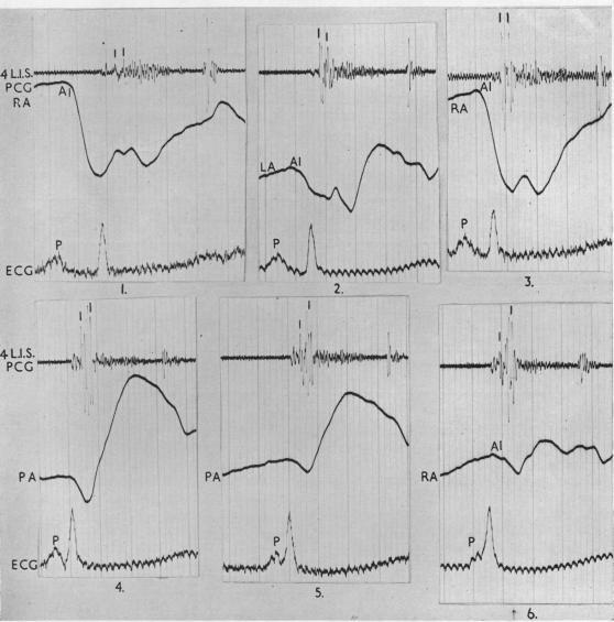 https://cdn.ncbi.nlm.nih.gov/pmc/blobs/20ae/503957/e8eff845fba3/brheartj00382-0035-a.jpg