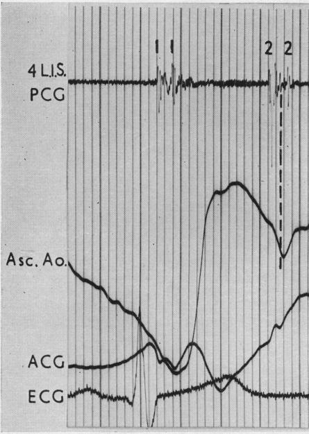 https://cdn.ncbi.nlm.nih.gov/pmc/blobs/20ae/503957/e9ff55861593/brheartj00382-0037-b.jpg