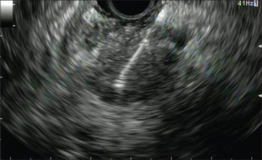 https://cdn.ncbi.nlm.nih.gov/pmc/blobs/20f3/6032705/6ef63f3f2605/EUS-7-141-g004.jpg