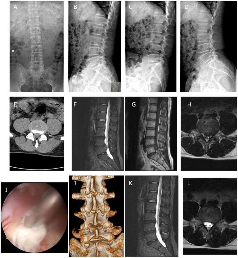 https://cdn.ncbi.nlm.nih.gov/pmc/blobs/2148/9099005/52abab935008/fsurg-09-873691-g0001.jpg