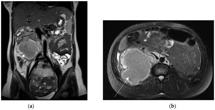 https://cdn.ncbi.nlm.nih.gov/pmc/blobs/2153/10528125/59c0c08b30e3/diagnostics-13-02909-g008.jpg