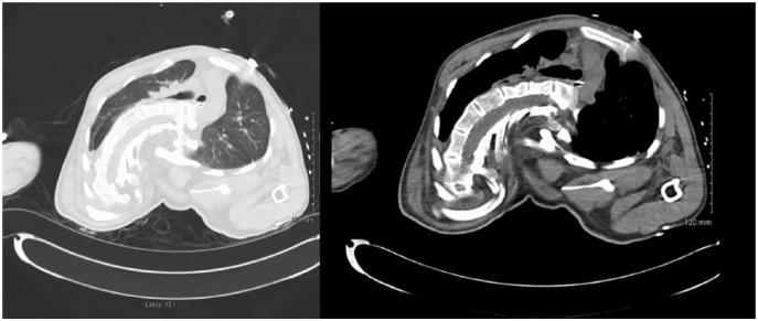 https://cdn.ncbi.nlm.nih.gov/pmc/blobs/2169/6350156/c1cb7fbdbd9c/10.1177_2324709618820660-fig3.jpg
