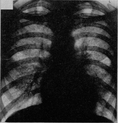https://cdn.ncbi.nlm.nih.gov/pmc/blobs/2193/1889210/1702179549a9/procrsmed00378-0129-a.jpg