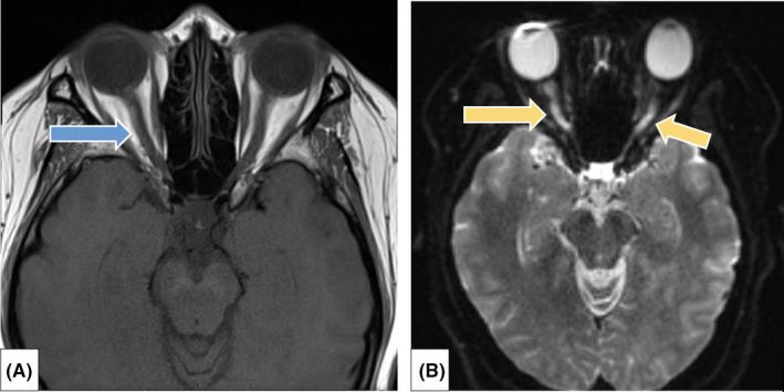 https://cdn.ncbi.nlm.nih.gov/pmc/blobs/2224/8190579/ff08c4df4317/CCR3-9-e04347-g002.jpg