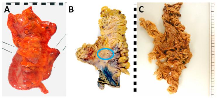 https://cdn.ncbi.nlm.nih.gov/pmc/blobs/2296/10452811/c1d73255a3d6/cancers-15-04116-g002.jpg