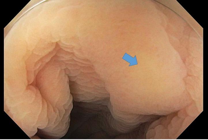https://cdn.ncbi.nlm.nih.gov/pmc/blobs/22d6/5856413/4d3ac09c224f/cureus-0010-00000002086-i01.jpg