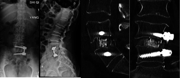 https://cdn.ncbi.nlm.nih.gov/pmc/blobs/22d9/11518842/57b33bd4ec43/fsurg-11-1487567-g004.jpg