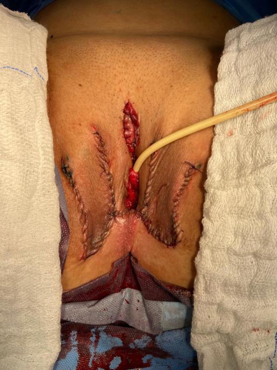 https://cdn.ncbi.nlm.nih.gov/pmc/blobs/22e8/8131861/35af26e1ac8b/fsurg-08-639430-g0007.jpg
