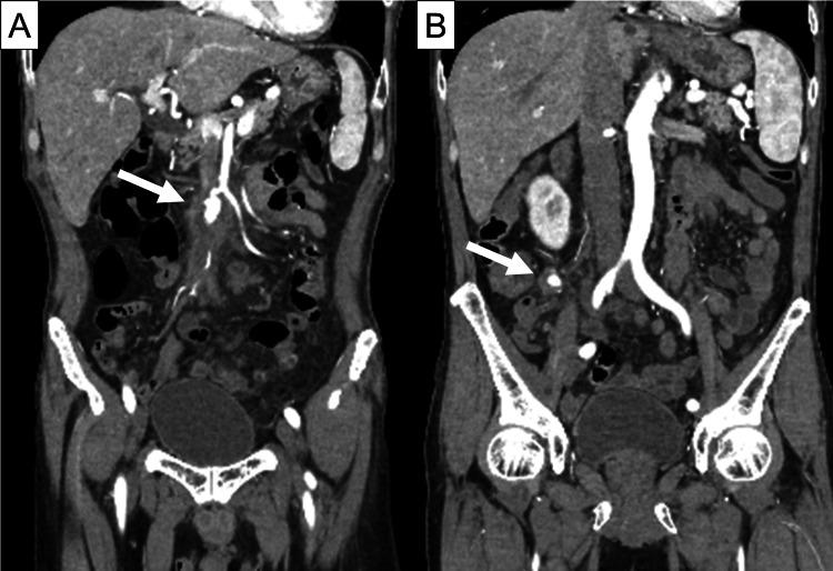 https://cdn.ncbi.nlm.nih.gov/pmc/blobs/230a/11436282/27a7fe02548f/cureus-0016-00000068056-i02.jpg