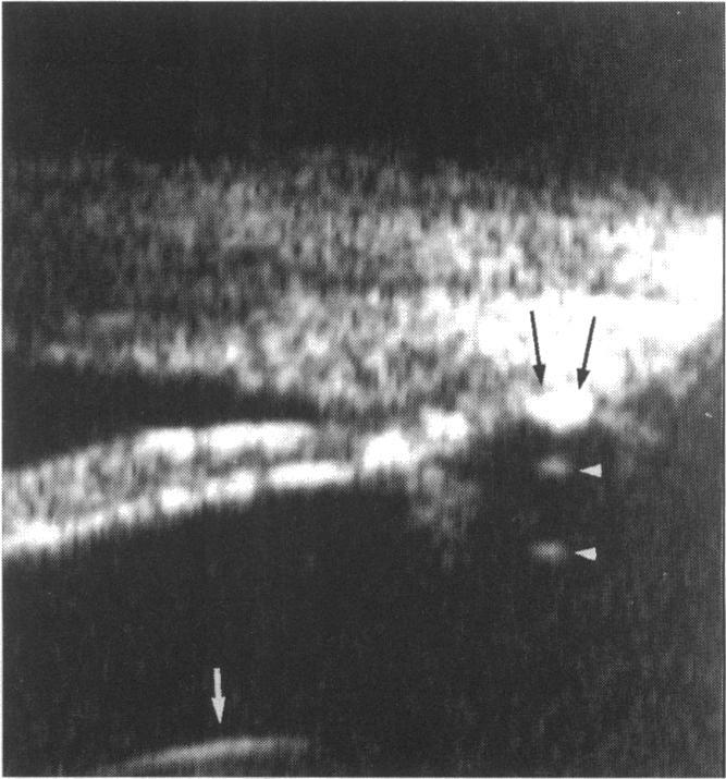 https://cdn.ncbi.nlm.nih.gov/pmc/blobs/2311/505300/922af5563982/brjopthal00022-0091-a.jpg