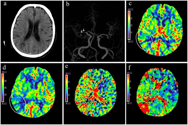 https://cdn.ncbi.nlm.nih.gov/pmc/blobs/232b/12158727/f76ce3d06c57/fneur-16-1551364-g003.jpg