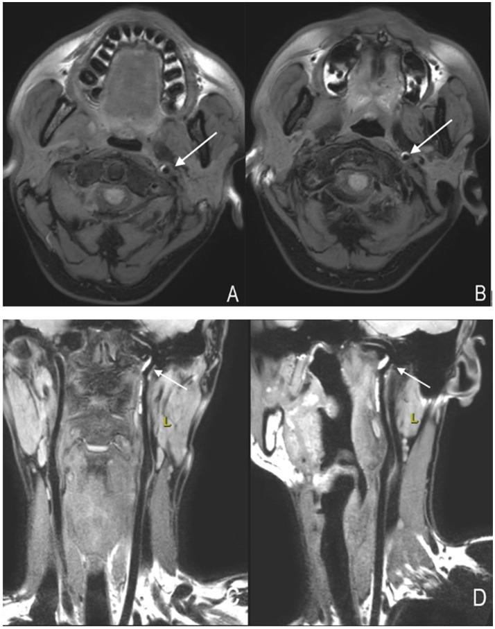 https://cdn.ncbi.nlm.nih.gov/pmc/blobs/236c/12282257/48807d51585c/fneur-16-1624698-g003.jpg