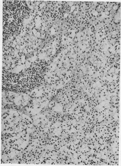 https://cdn.ncbi.nlm.nih.gov/pmc/blobs/2379/1023967/da1e02450f0d/jclinpath00037-0029-b.jpg