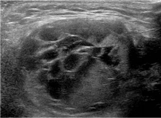 https://cdn.ncbi.nlm.nih.gov/pmc/blobs/237b/7065985/f2a58ed2c07c/usg-19041f10.jpg