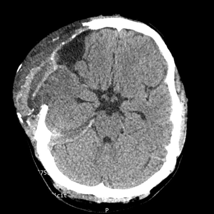 https://cdn.ncbi.nlm.nih.gov/pmc/blobs/238d/10499499/9ee6024662d8/cureus-0015-00000043485-i03.jpg