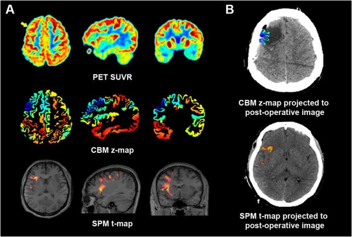 https://cdn.ncbi.nlm.nih.gov/pmc/blobs/23d9/12008173/ee26cfb18005/CNS-31-e70336-g003.jpg