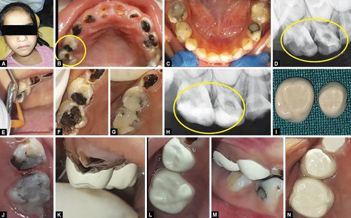 https://cdn.ncbi.nlm.nih.gov/pmc/blobs/243c/11320795/cca9d08761a5/ijcpd-17-357-g003.jpg