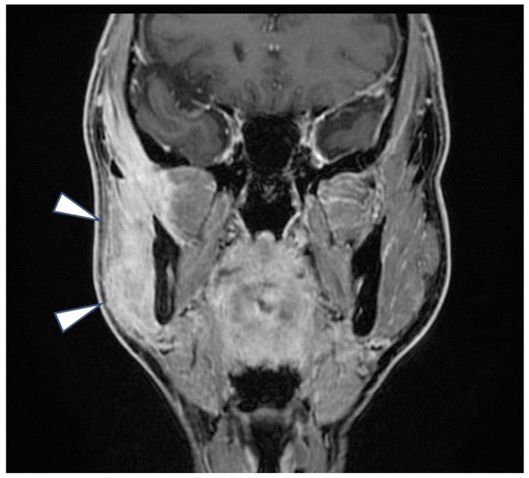 https://cdn.ncbi.nlm.nih.gov/pmc/blobs/2450/12375442/4ce32853c4b7/cureus-0017-00000088768-i05.jpg