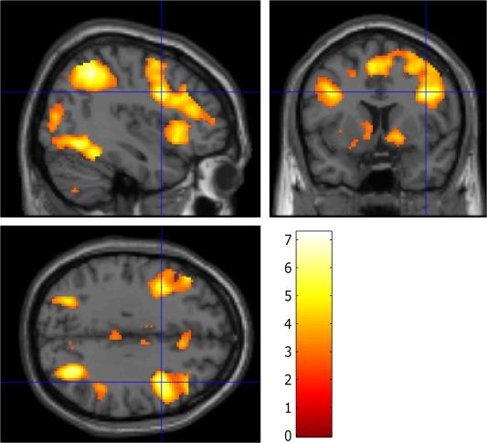 https://cdn.ncbi.nlm.nih.gov/pmc/blobs/2484/6869054/fd986bab6499/HBM-35-5141-g002.jpg