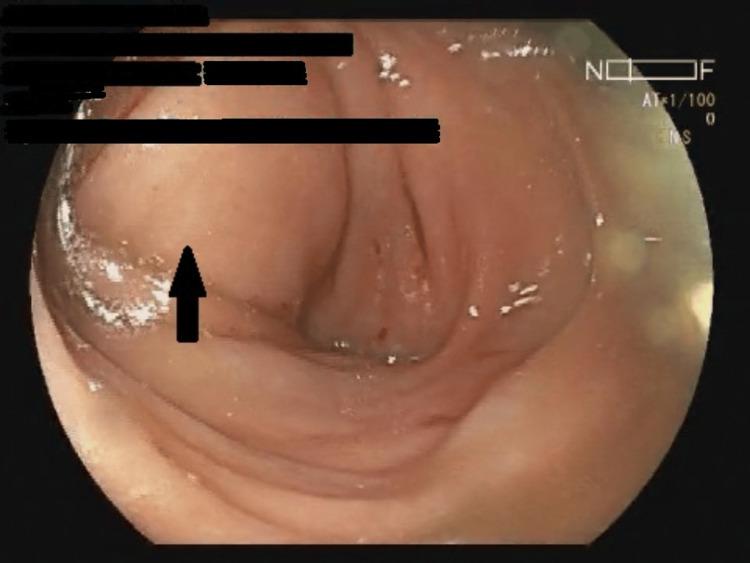 https://cdn.ncbi.nlm.nih.gov/pmc/blobs/24de/11522948/945d3e5c0ebe/cureus-0016-00000070485-i02.jpg