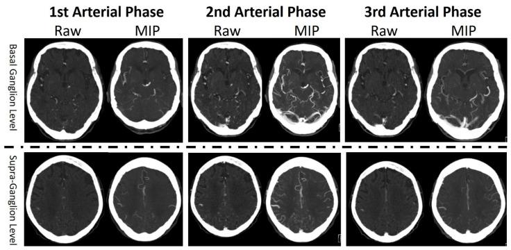 https://cdn.ncbi.nlm.nih.gov/pmc/blobs/24e0/10037617/38c56e65b505/tomography-09-00052-g001.jpg